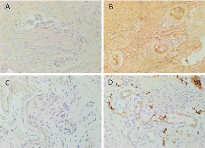 Expression of Components of the Renin-Angiotensin System by the Putative Stem Cell Population Within WHO Grade I Meningioma